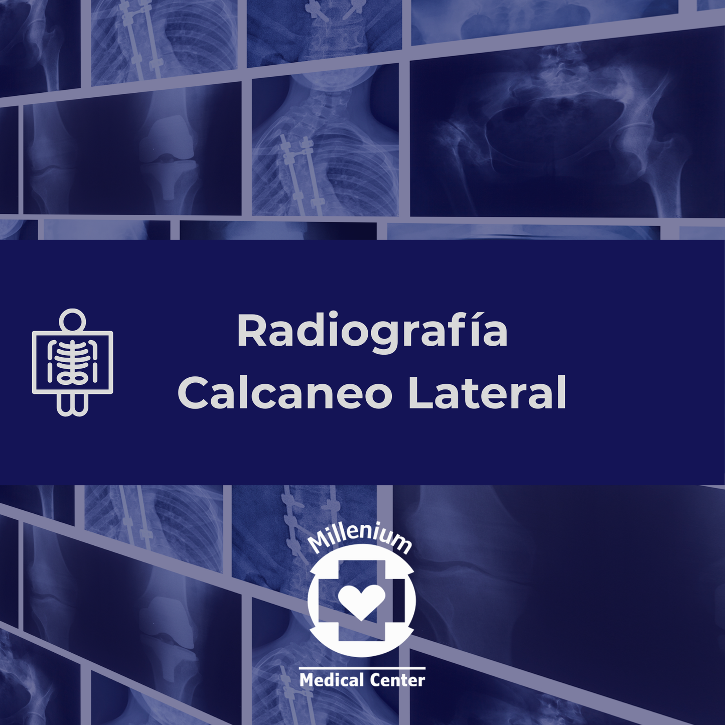 Calcaneo lateral
