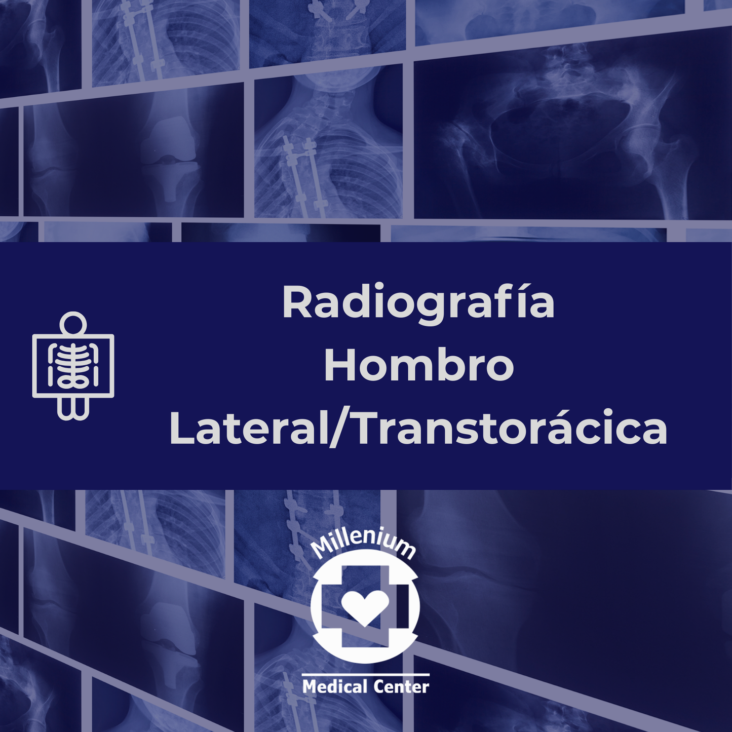 Hombro lateral/transtoracica