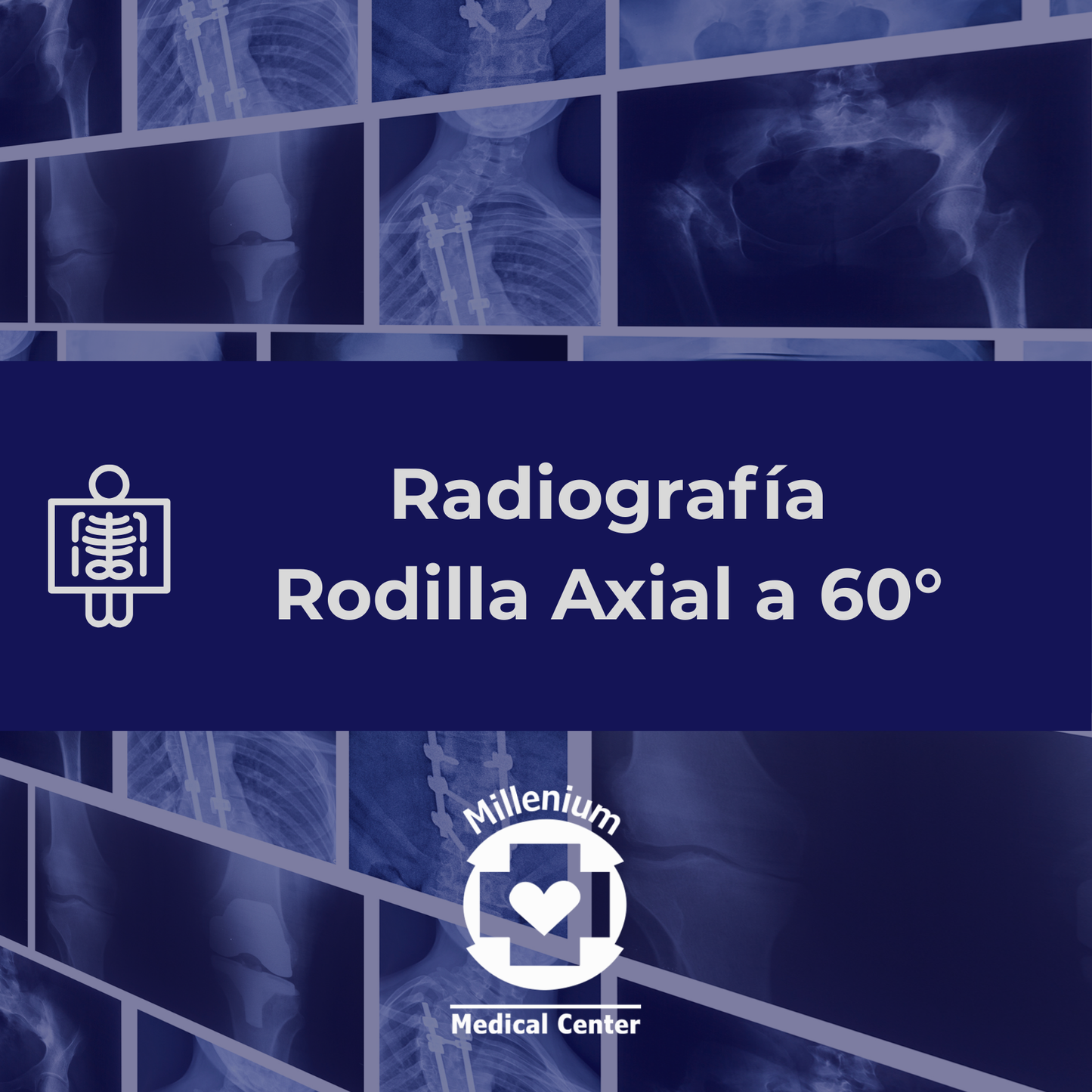 Rodilla axial a 60°