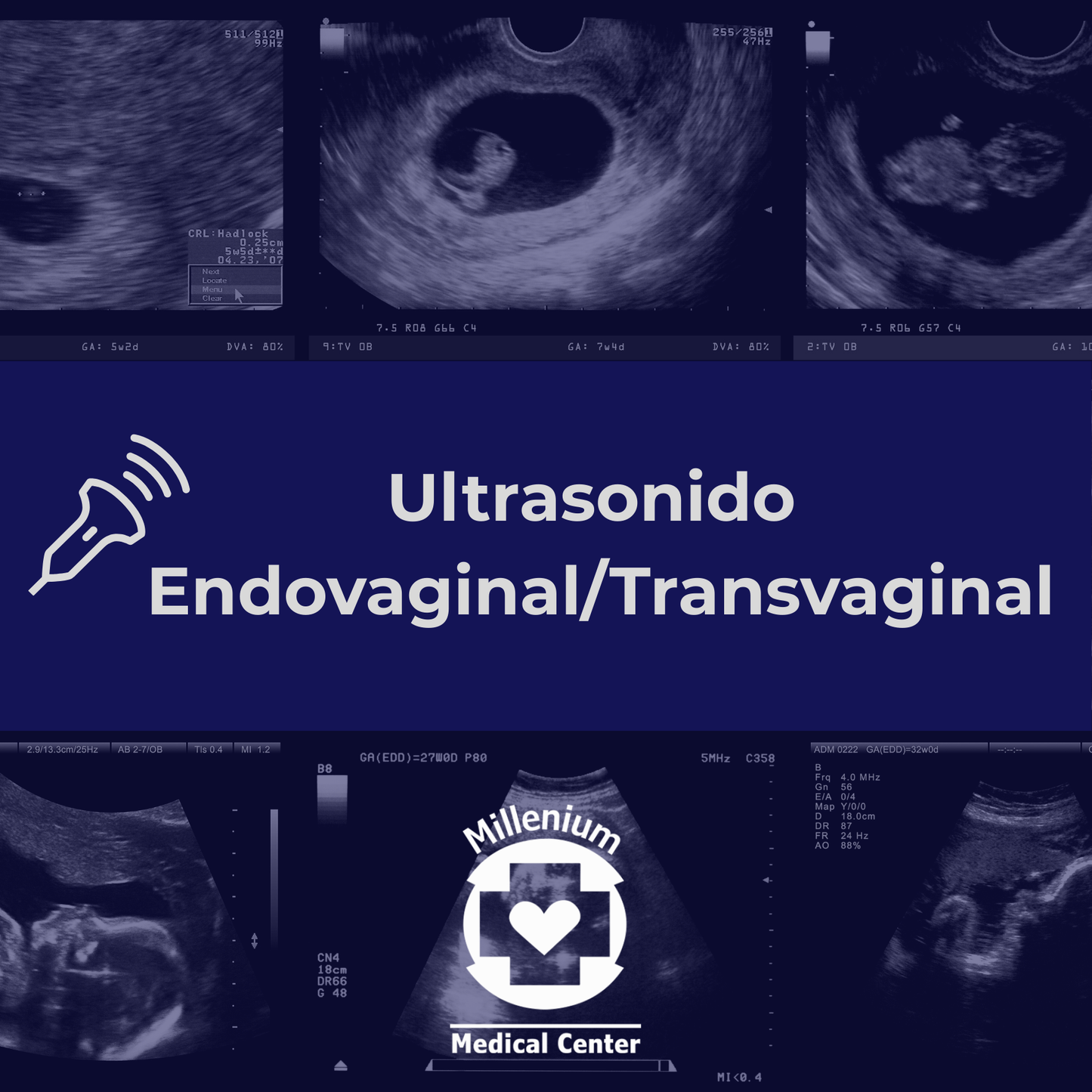 Ultrasonido Endovaginal/Transvaginal