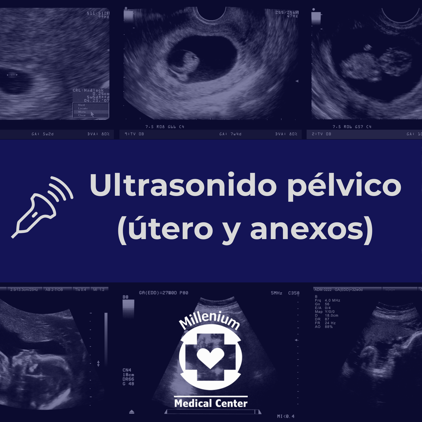 Ultrasonido Pélvico (útero y Anexos)