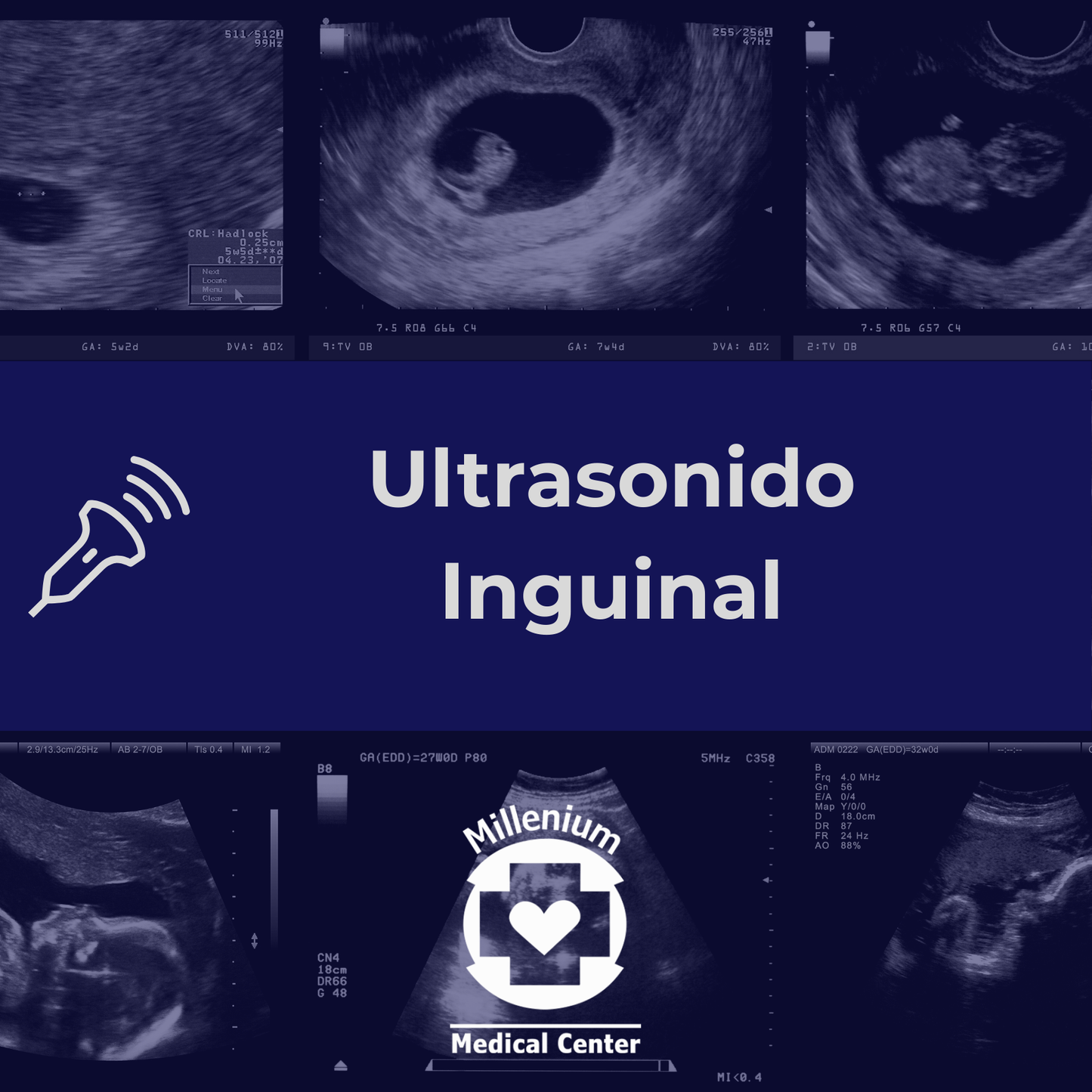 Ultrasonido Inguinal