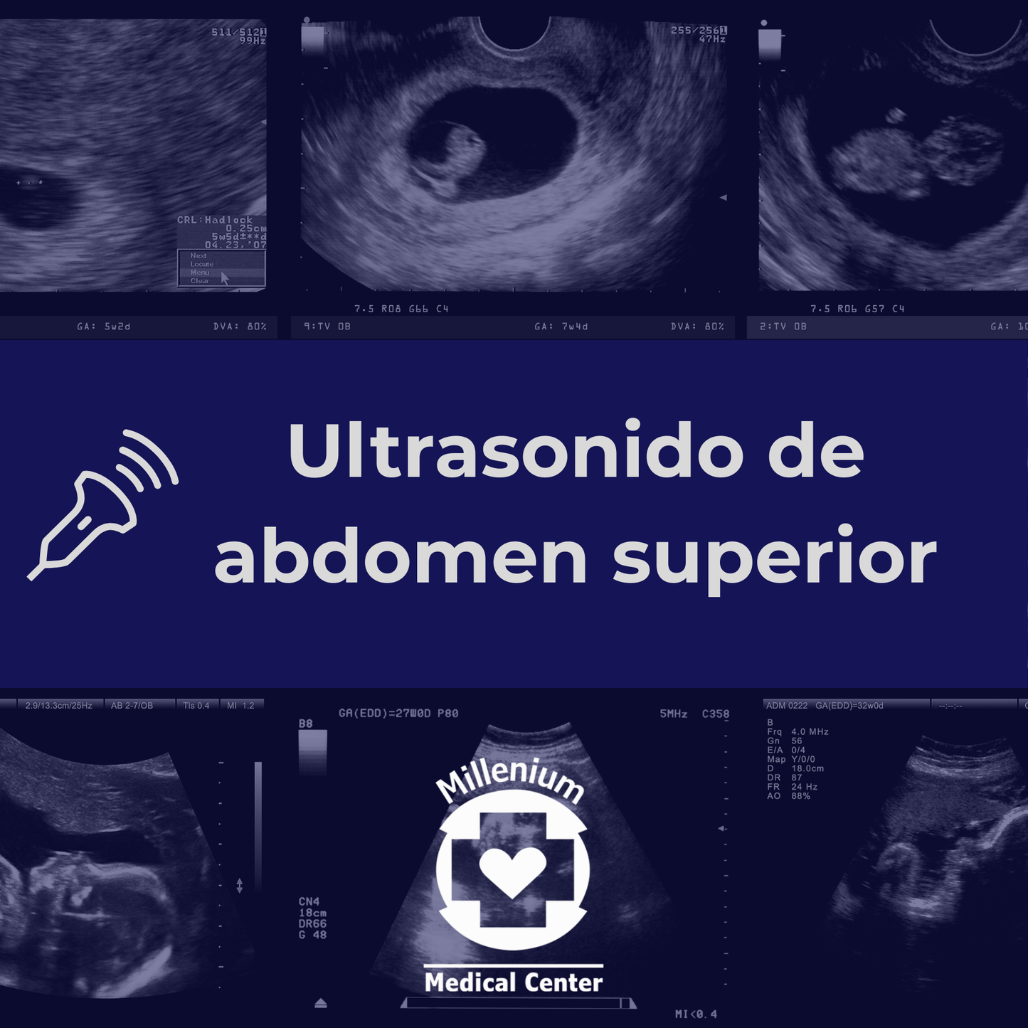 Ultrasonido de Abdomen Superior