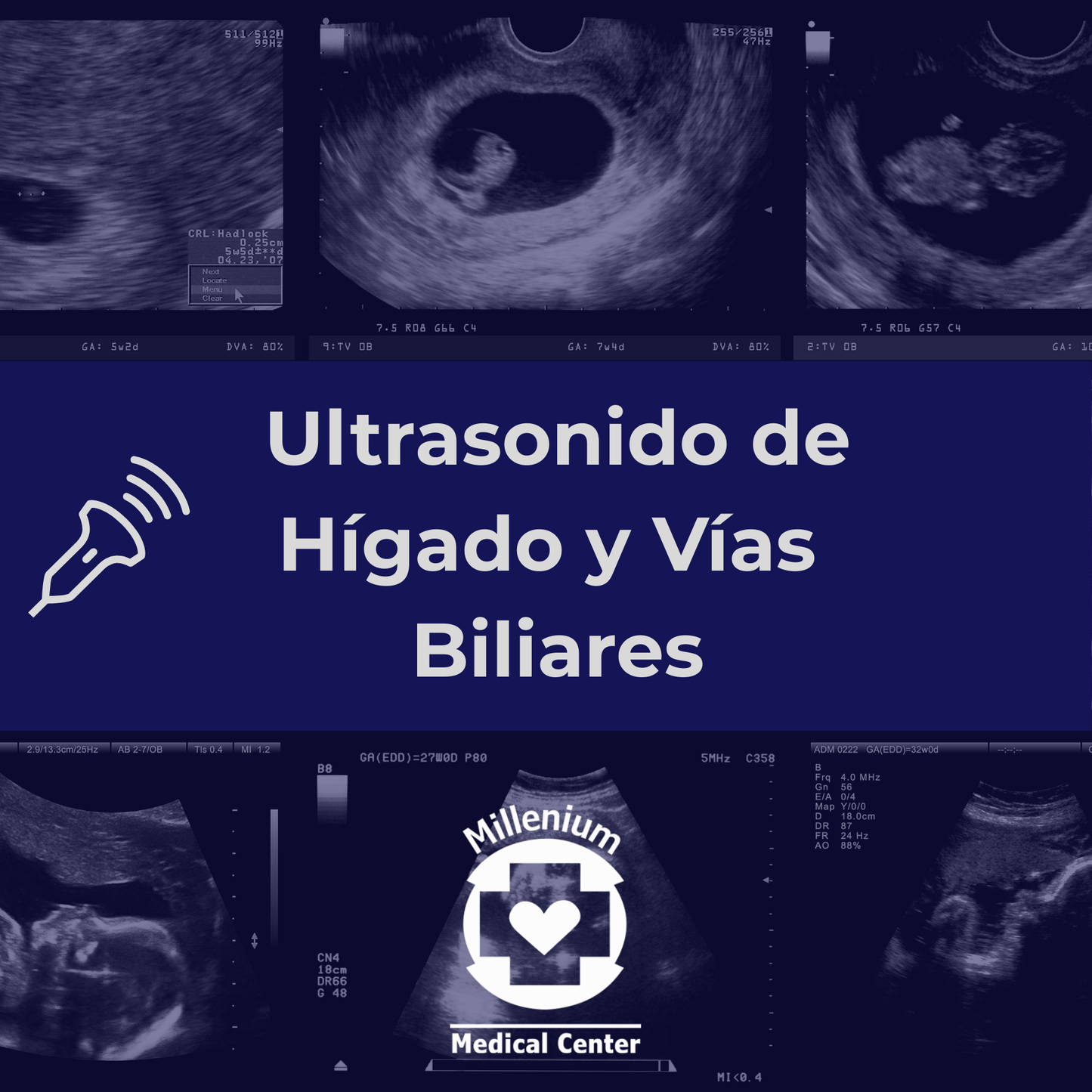 Ultrasonido Hígado y Vías Biliares