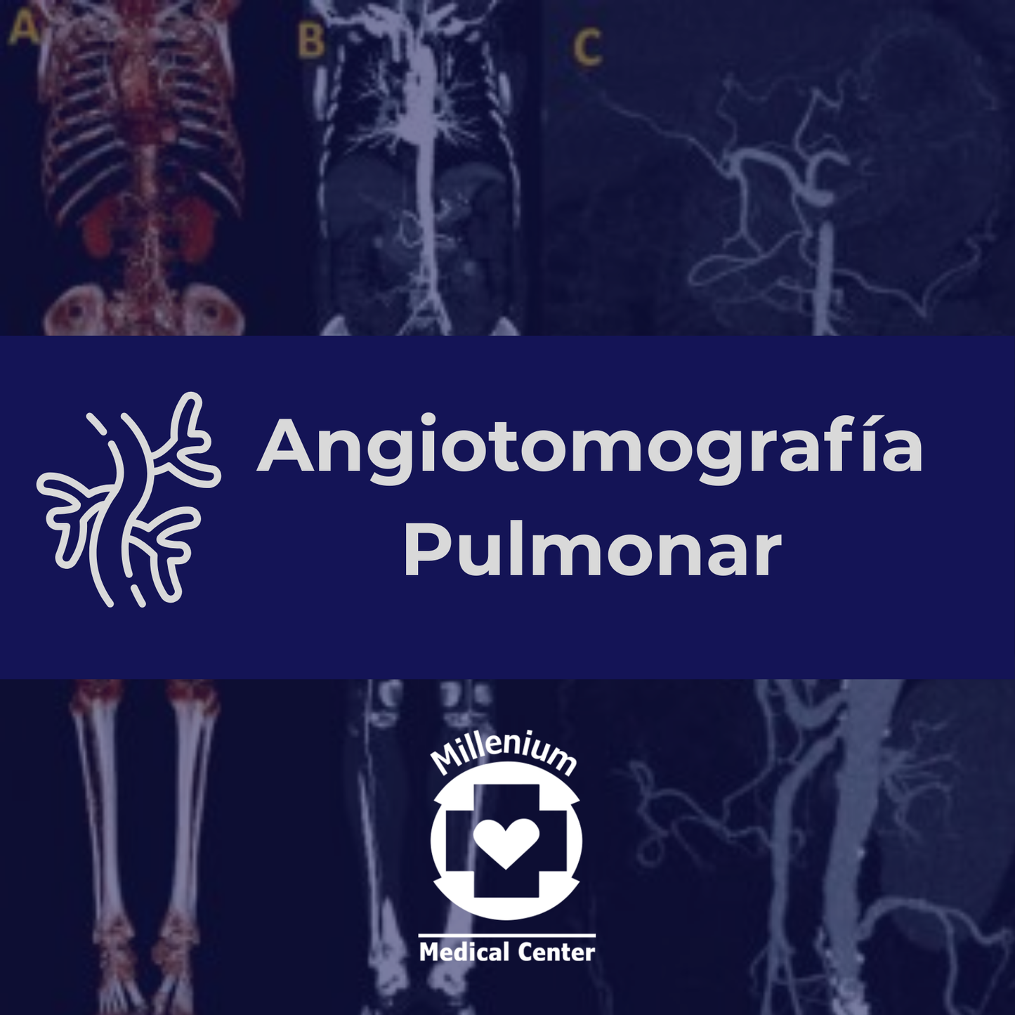 Angiotomografía Pulmonar